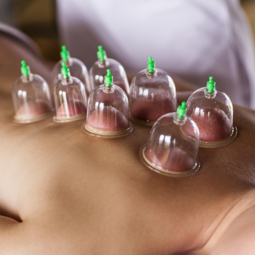 cupping-CareCo-Physio-and-Massage-Maple-Ridge-BC