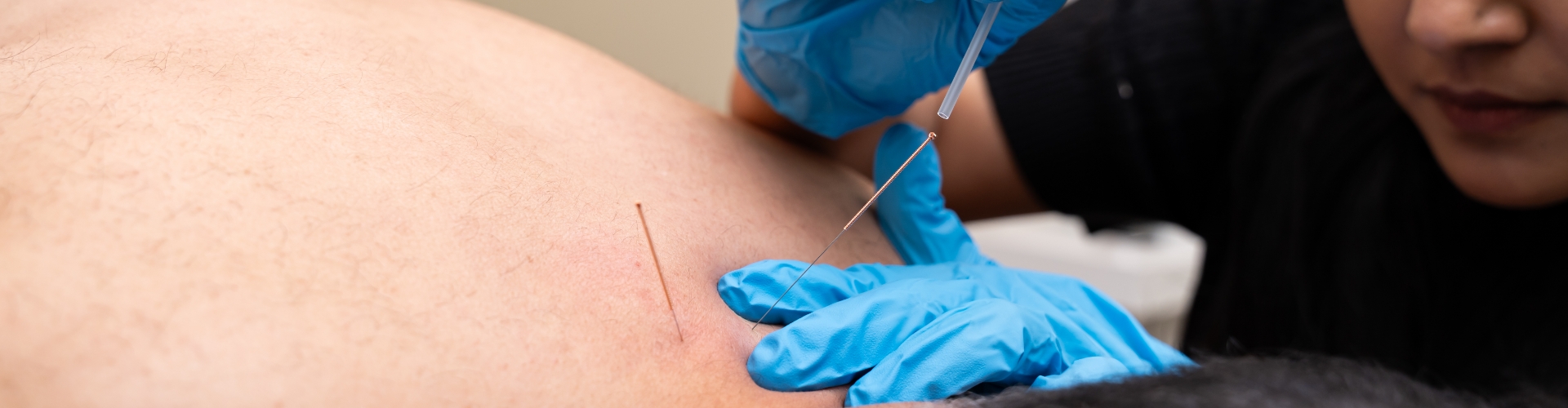 dry-needling-CareCo-Physio-and-Massage-Maple-Ridge-BC-1920x500