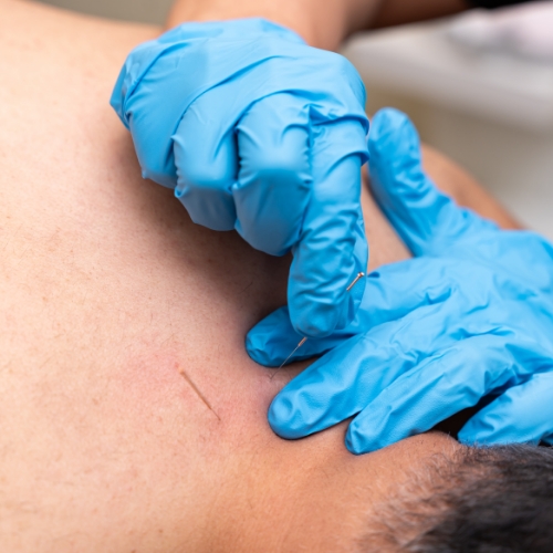 dry-needling-CareCo-Physio-and-Massage-Maple-Ridge-BC
